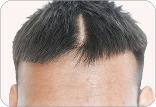 Che phủ sẹo