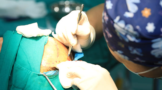 Cấy tóc tự thân