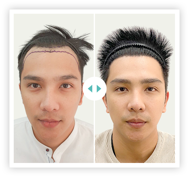 khách hàng cấy 2700 nang HAT