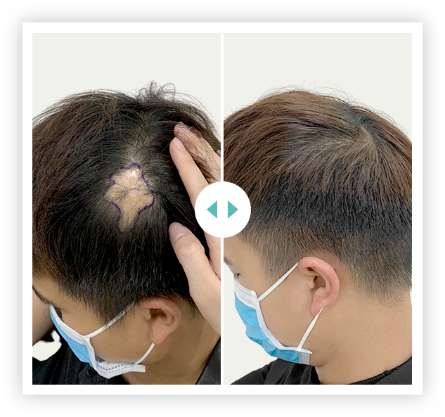 khách hàng cấy 2700 nang HAT