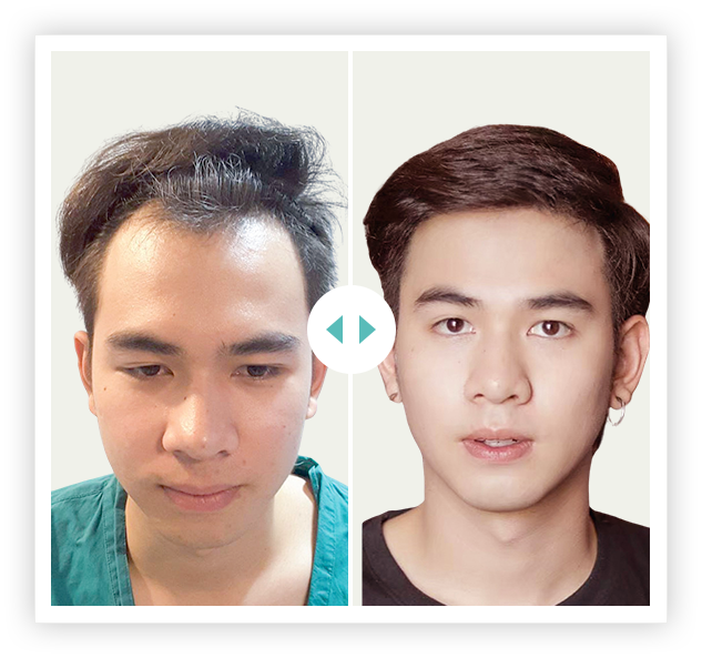 khách hàng cấy 2700 nang HAT