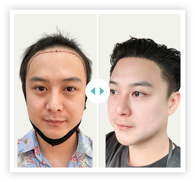 khách hàng cấy 2700 nang HAT