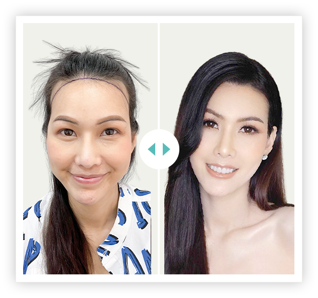 khách hàng cấy 2700 nang HAT