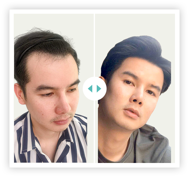 khách hàng cấy 2700 nang HAT