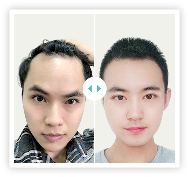 khách hàng cấy 2700 nang HAT