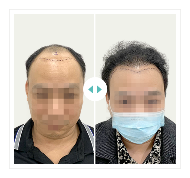 khách hàng cấy 2700 nang HAT