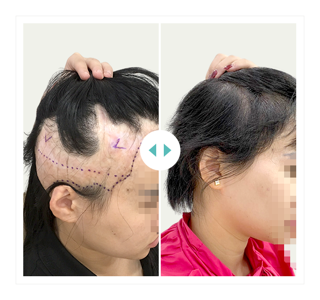 khách hàng cấy 2700 nang HAT