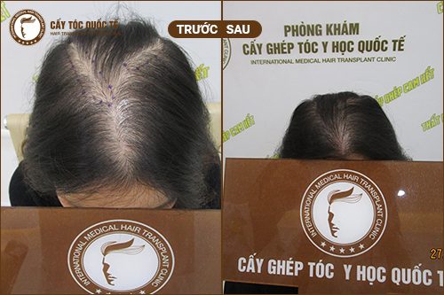 Hình ảnh trước và sau cấy tóc tự thân 6 tháng 
