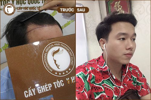 Hình ảnh trước và sau khi cấy tóc thẩm mỹ 