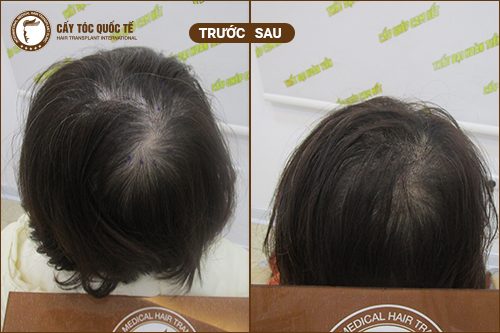 Hình ảnh trước và sau khi cấy tóc tự thân được 6 tháng 