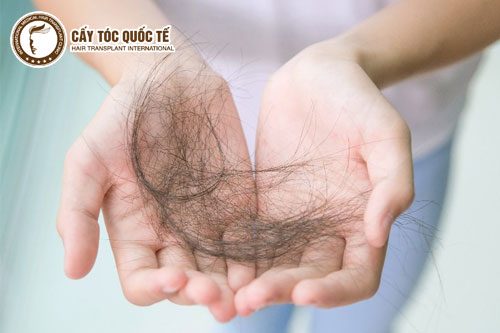Bệnh rụng tóc có khiến bạn lo lắng?