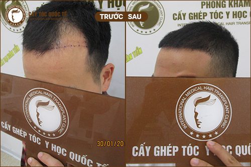 Hình ảnh trước và sau 6 tháng cấy tóc tự thân chữa hói trán chữ M 