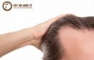 Tìm hiểu hiện tượng rụng tóc nhiều ở nam giới và cách phòng tránh