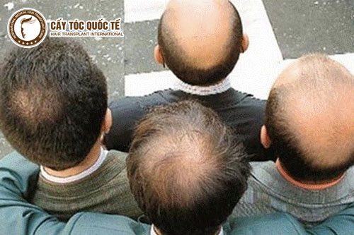 Hói đầu ở nam do di truyền chiếm tỷ lệ rất cao 