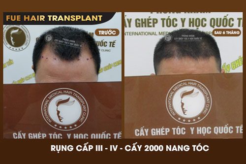 Hình ảnh trước và sau khi cấy tóc tự thân trị hói trán