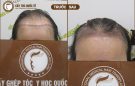 Phương pháp cấy tóc nữ giới  có điểm gì đặc biệt?