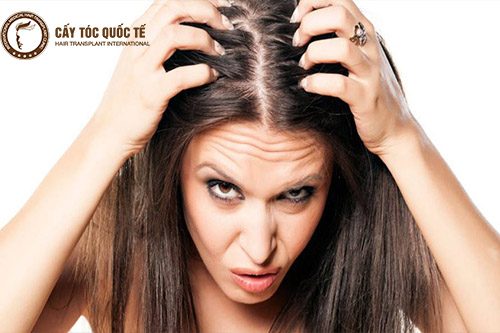 Tóc rụng nhiều da đầu ngứa là 1 trong những dấu hiệu của hói đầu nữ
