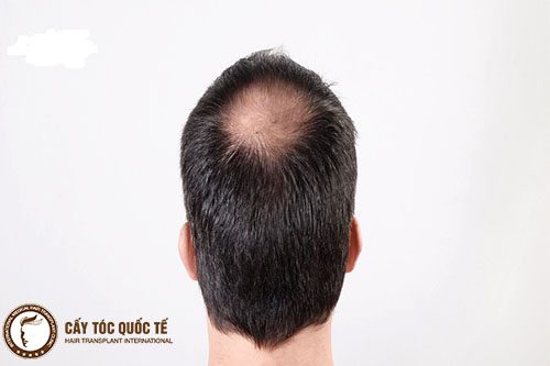 Rụng tóc nhiều xung quanh đỉnh đầu dẫn đến hói đầu 