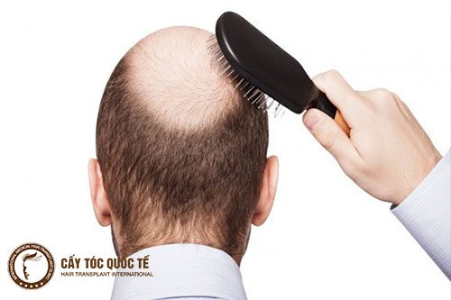 Rụng tóc nhiều ở phần đỉnh đầu dẫn đến hói đỉnh đầu ở nam giới