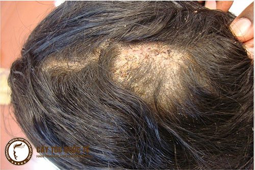 Bệnh lý da đầu cũng là tác nhân gây nên rụng tóc hói đầu