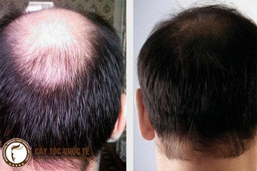 Hình ảnh trước và sau khi thực hiện cấy tóc tự thân hói đỉnh đầu