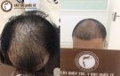 Xóa bỏ nỗi lo “rụng tóc hói đầu”với công nghệ hiện đại