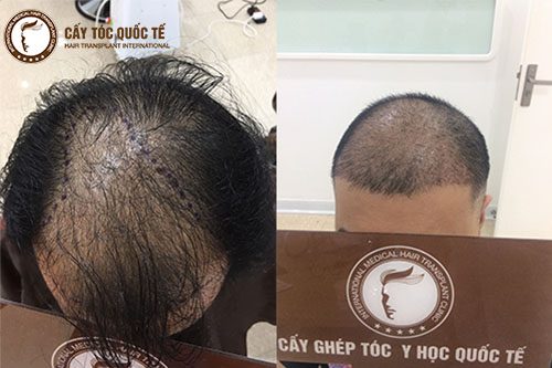 Hình Ảnnh Trước(Trái) Và Sau( Phải ) Khi Cấy Tóc Tự Thân Trị Rụng Tóc Mỏng Được 3 Tháng 
