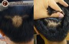 Rụng tóc từng mảng là gì ? Cách điều trị ?