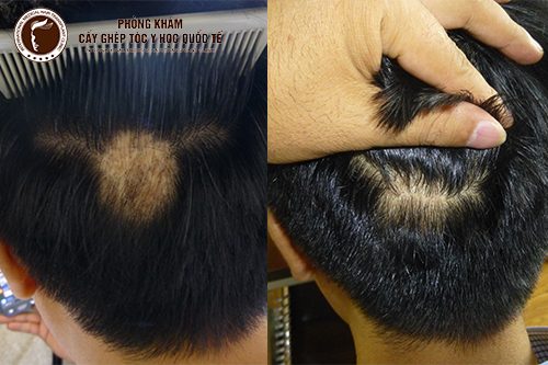 Rụng tóc từng mảng là gì ? Cách điều trị ?