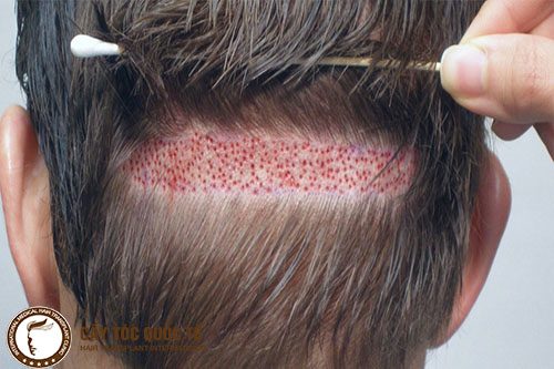 Bóc tách nang tóc chắc khỏe ở phần sau gáy để cấy lên phần bị hói 