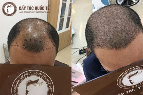 Hình ẢNH Trước Và Sau Khi Cấy Tóc Tự Thân Trị Bệnh Hói Đầu Được 3 Tháng 