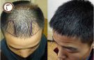 Nguyên nhân hói đầu ở nam giới-Phương pháp Trị hói