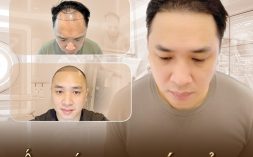 Làm gì để xóa tan nỗi lo rụng tóc hói đầu?
