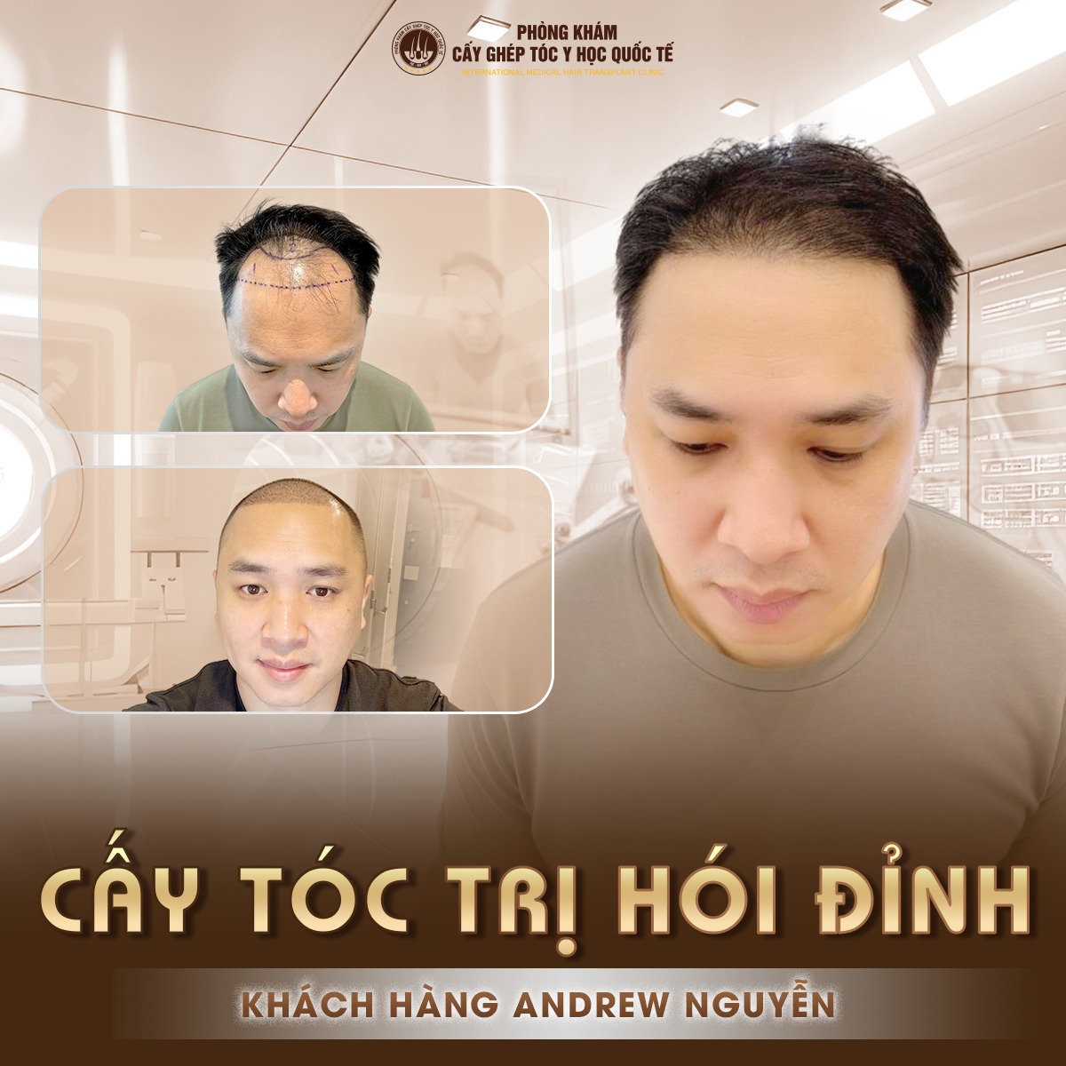 Làm gì để xóa tan nỗi lo rụng tóc hói đầu?