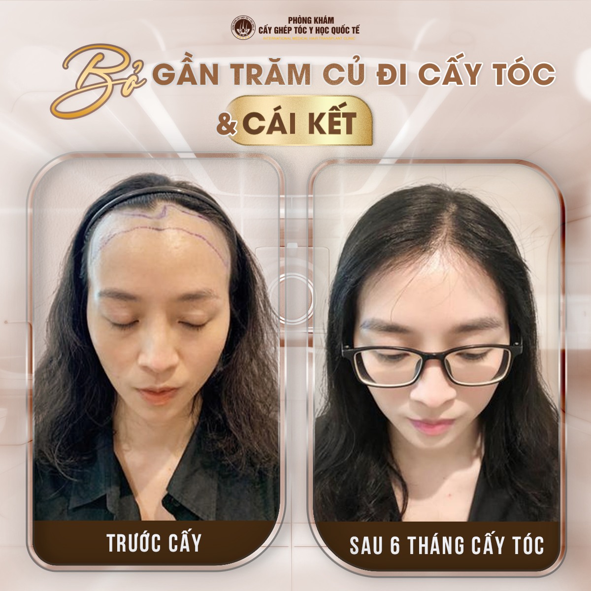 Hói đầu ở nữ giới-Nguyên nhân và biện pháp chữa trị