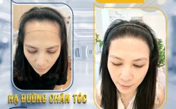 Trán cao bẩm sinh – Nỗi khổ của nàng trán “sân bay”