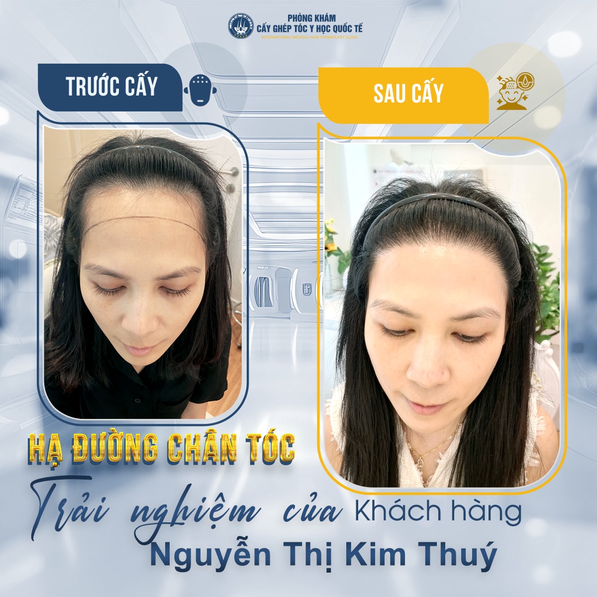Trán cao bẩm sinh – Nỗi khổ của nàng trán “sân bay”