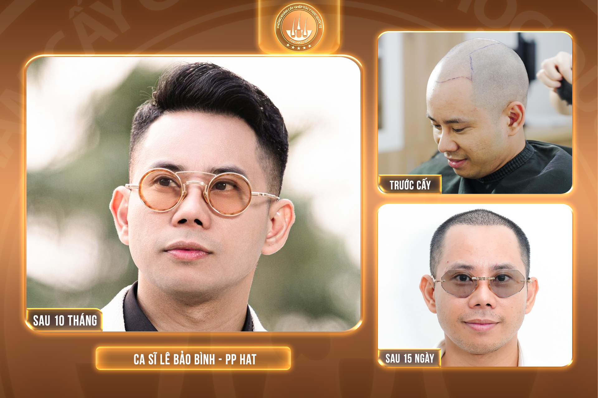 Hy vọng nào cho người trán cao bẩm sinh?