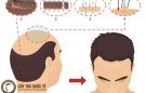 Cấy tóc tự thân FUE – Công nghệ trị hói an toàn, không phẫu thuật