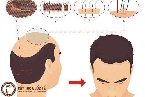 Cấy tóc tự thân – giải pháp hàng đầu khắc phục tóc thưa mỏng, hói tóc bẩm sinh