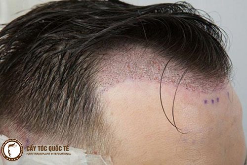 Hình ảnh cấy tóc sinh học bị sừng hóa viêm da đầu 