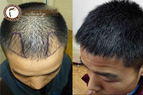 Hình ảnh trước và sau khi cấy tóc dày đc 6 tháng 