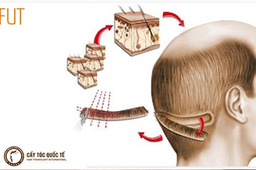 hình ảnh quy trình lấy nang tóc để cấy trong phương pháp cấy tóc Fut