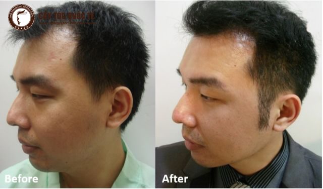 Hình ảnh Cấy Tóc Mai Tự thân trước và sau 6 tháng 