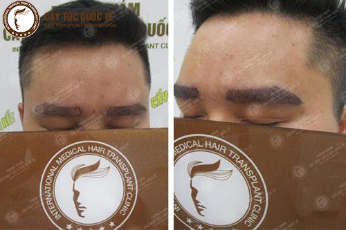 Hình Ảnh Trước ( trái ) - Sau ( phải ) khi cấy lông mày Tại PK Cấy Tóc Quốc Tế 260 Nguyễn Đình Chiểu