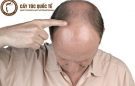 Rụng tóc nam giới: Nguyên nhân và cách điều trị