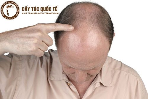 Rụng tóc nam giới: Nguyên nhân và cách điều trị