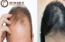 Tóc rụng mỏng – Bạn đã biết cách khắc phục?