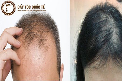 Tóc rụng mỏng – Bạn đã biết cách khắc phục?