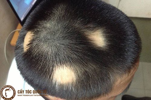 Tóc Rụng từng mảng – làm thế nào để tóc mọc lại?